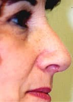 photo rhinoplasty after