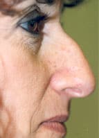 photo rhinoplasty before