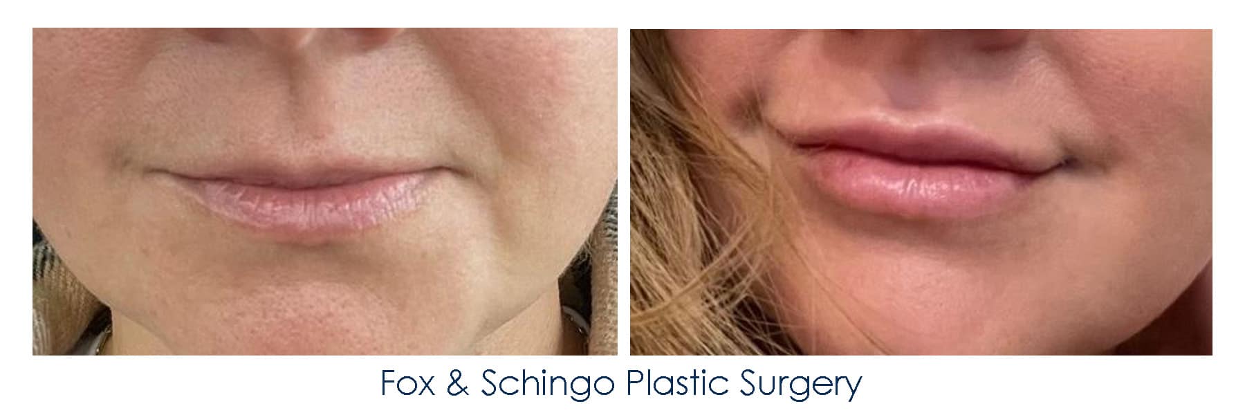 Lips Rha Line RHA for lips – Fox & Schingo Plastic Surgery