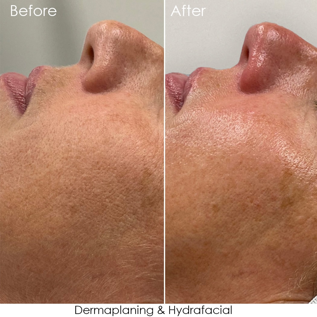 mhs Hydrafacial Enhanced Pre Post copy