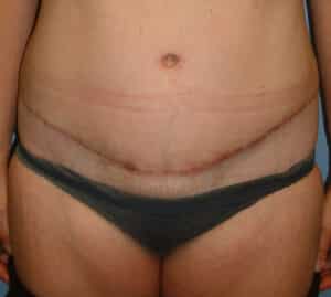 Abdominoplasty