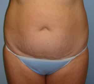 Abdominoplasty