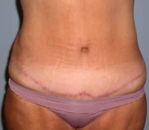 Abdominoplasty