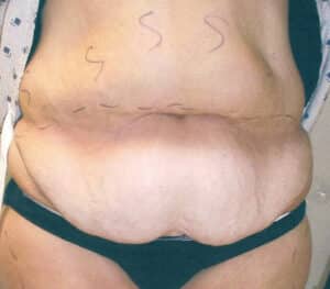 Abdominoplasty