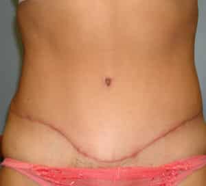 Abdominoplasty