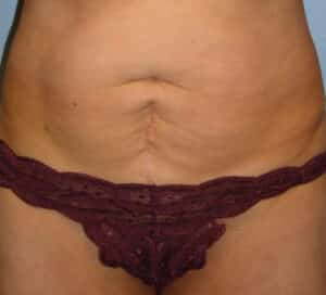 Abdominoplasty