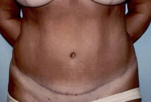 Abdominoplasty