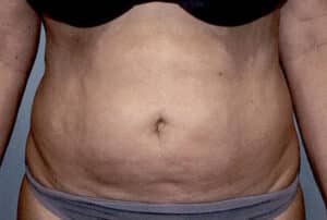 Abdominoplasty