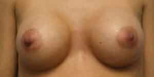 Breast Augmentation