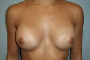 Breast Augmentation