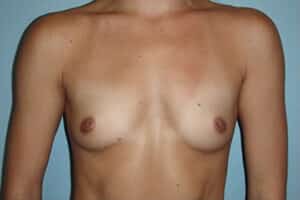 Breast Augmentation