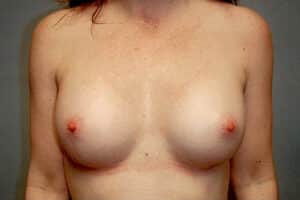 Breast Augmentation