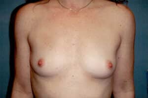 Breast Augmentation