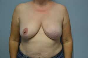 Breast Reconstruction