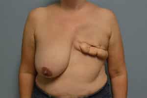 Breast Reconstruction