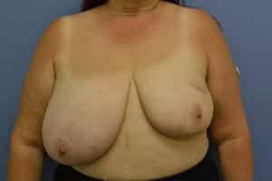 Breast Reconstruction