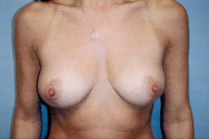 Breast Reduction