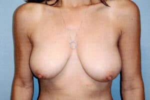 Breast Reduction