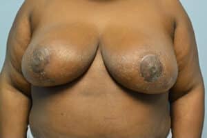 Breast Reduction