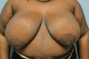 Breast Reduction