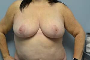 Breast Reduction