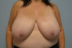 Breast Reduction