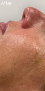 Hydrafacial