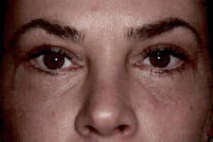 Blepharoplasty