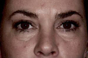 Blepharoplasty