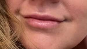 RHA Lip Enhancement