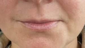 RHA Lip Enhancement