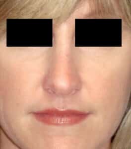 Rhinoplasty