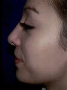 Rhinoplasty