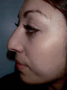 Rhinoplasty