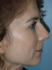 Rhinoplasty