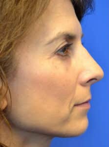 Rhinoplasty