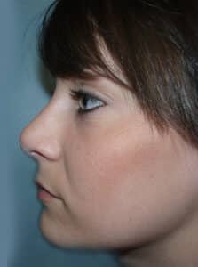 Rhinoplasty