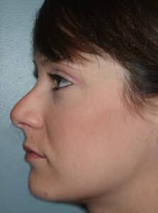 Rhinoplasty