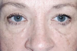 Blepharoplasty