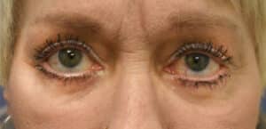 Blepharoplasty