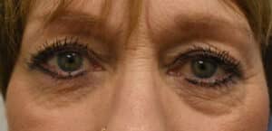 Blepharoplasty