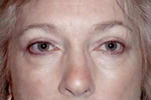 Blepharoplasty