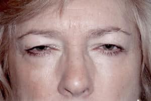 Blepharoplasty