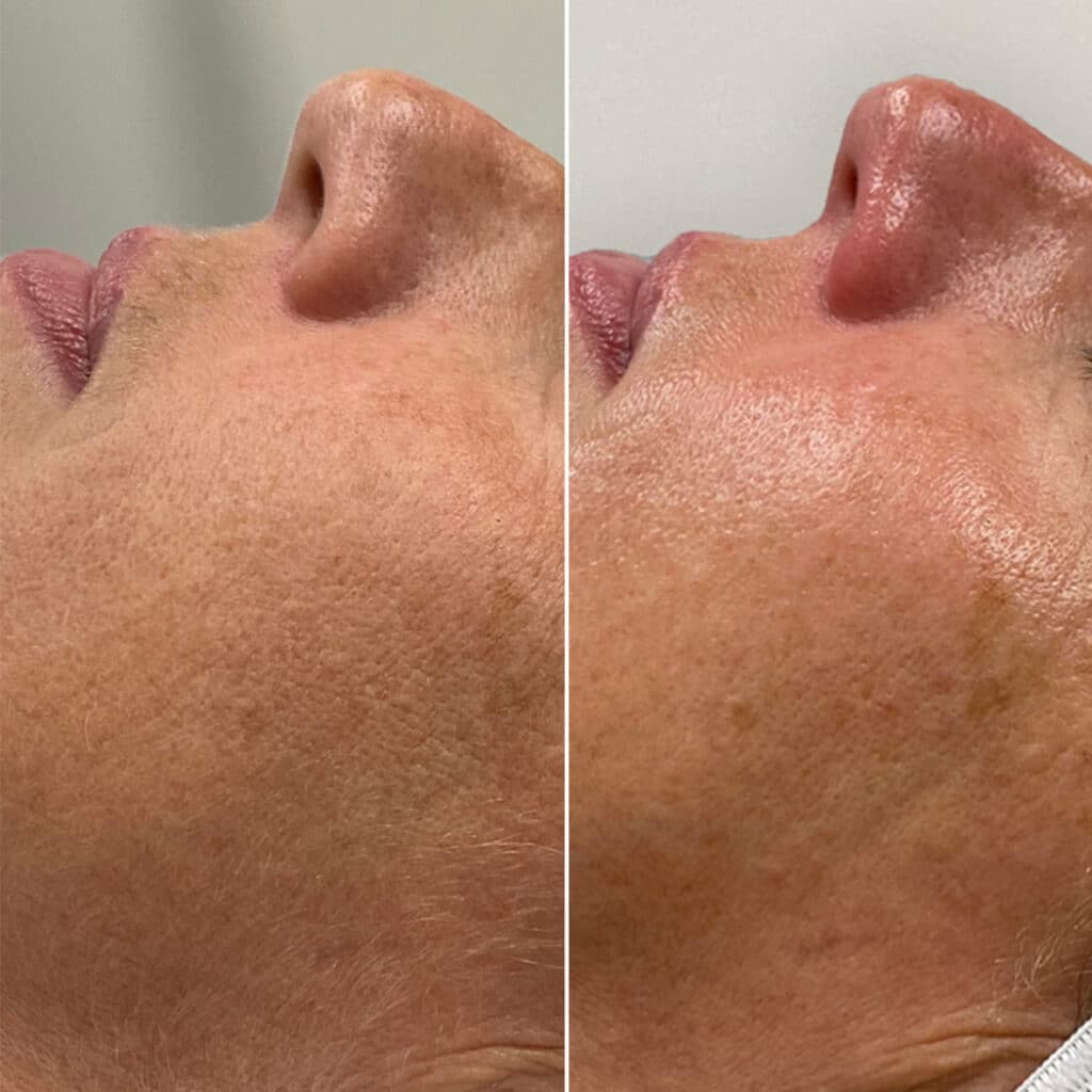 Dermaplaning with Hydrafacial