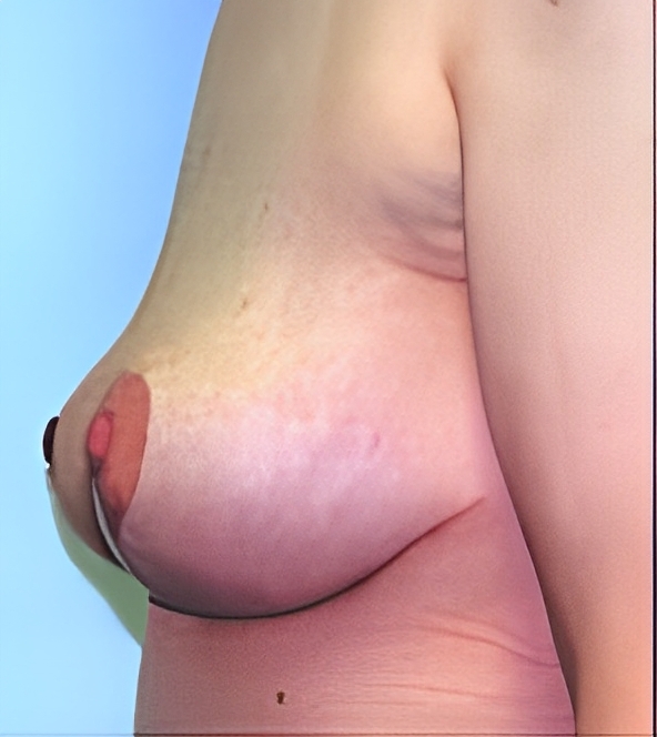 photo breastlift after01(1) photo breastlift after01(1)