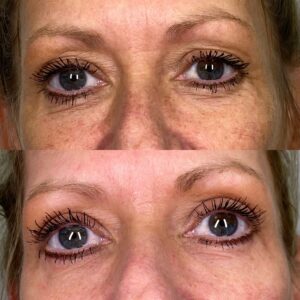Sylfirm X Microneedling Sylfirm X Microneedling