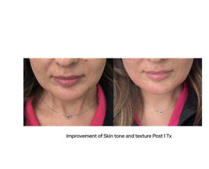 Sylfirm X before & after