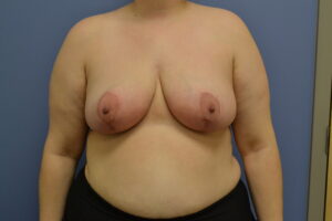 After Image: Breast Reduction