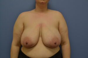Before Image: Breast Reduction