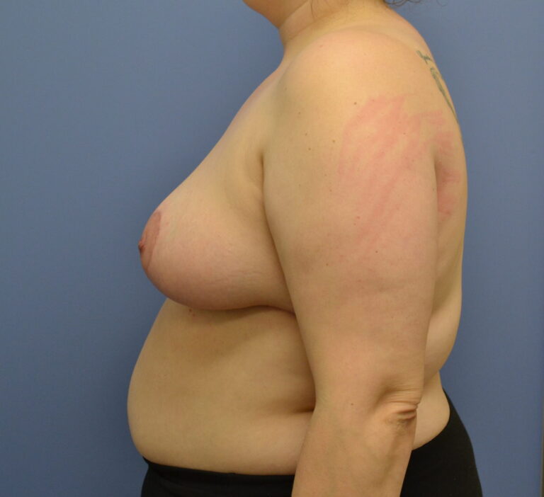 After Image: Breast Reduction - left-side